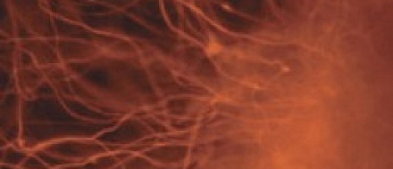 Белок PCSK9 определяет, как раковые клетки поджелудочной железы метастазируют в различные части тела